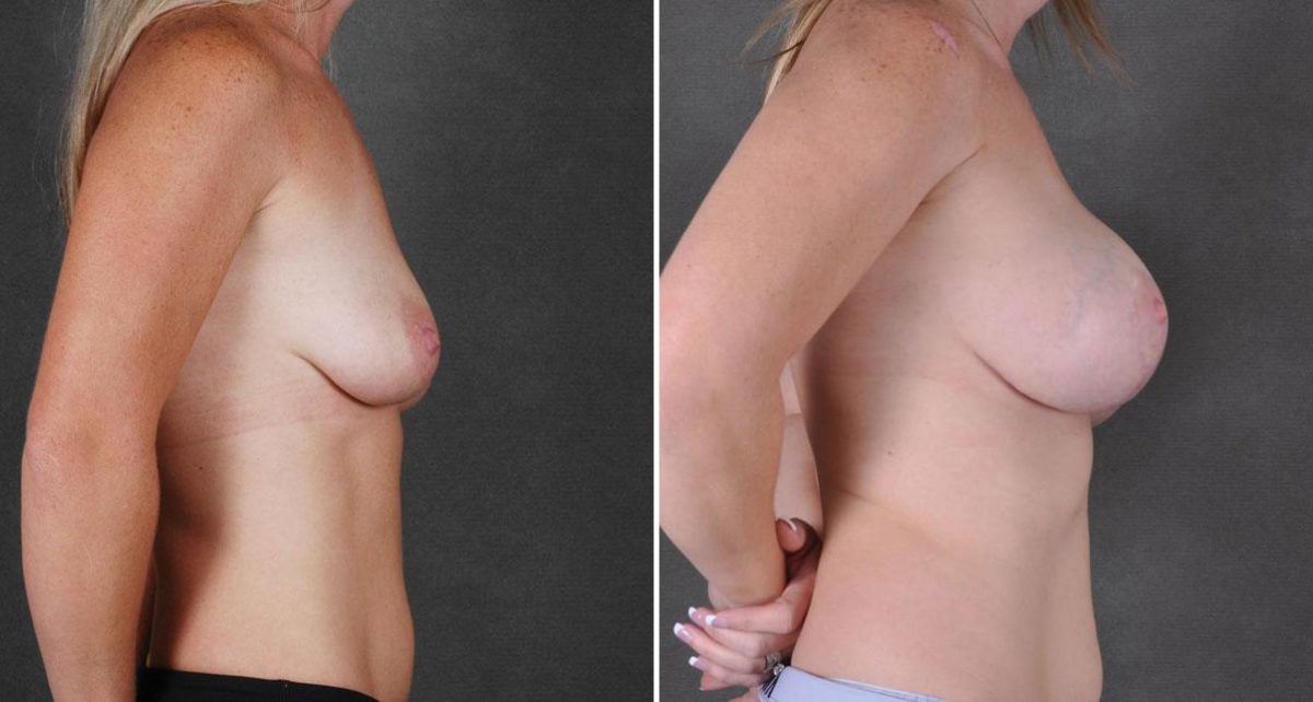 Breast Augmentation Before and After Photos in Omaha, NE, Case 9095