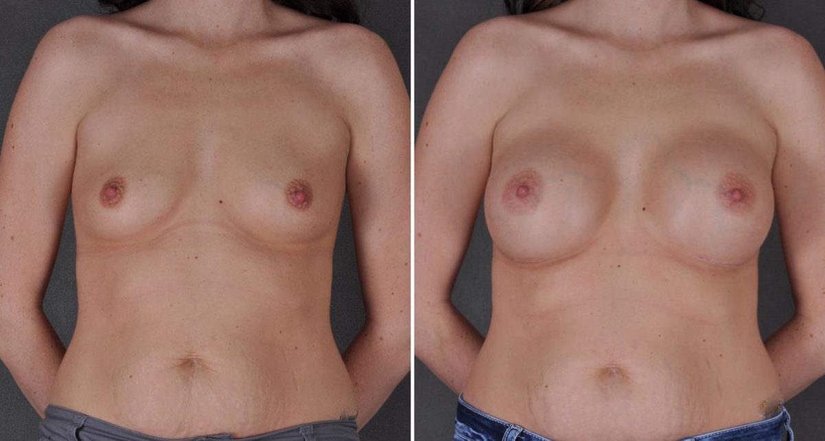 Breast Augmentation Before and After Photos in Omaha, NE, Case 8996