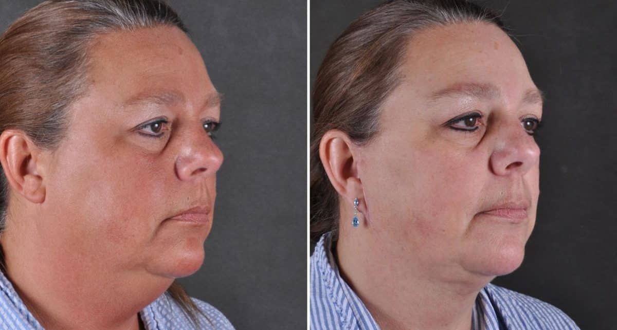 Facelift Before and After Photos in Omaha, NE, Case 8995