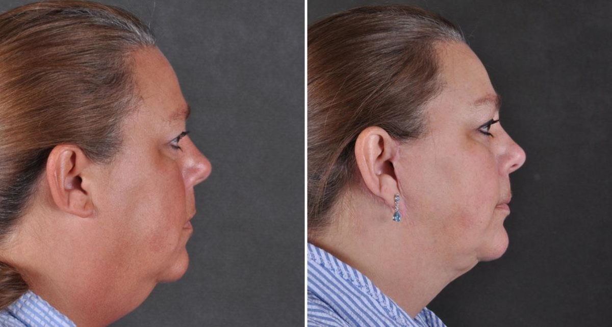 Facelift Before and After Photos in Omaha, NE, Case 8995