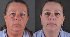 Facelift Before and After Photos in Omaha, NE, Case 8995