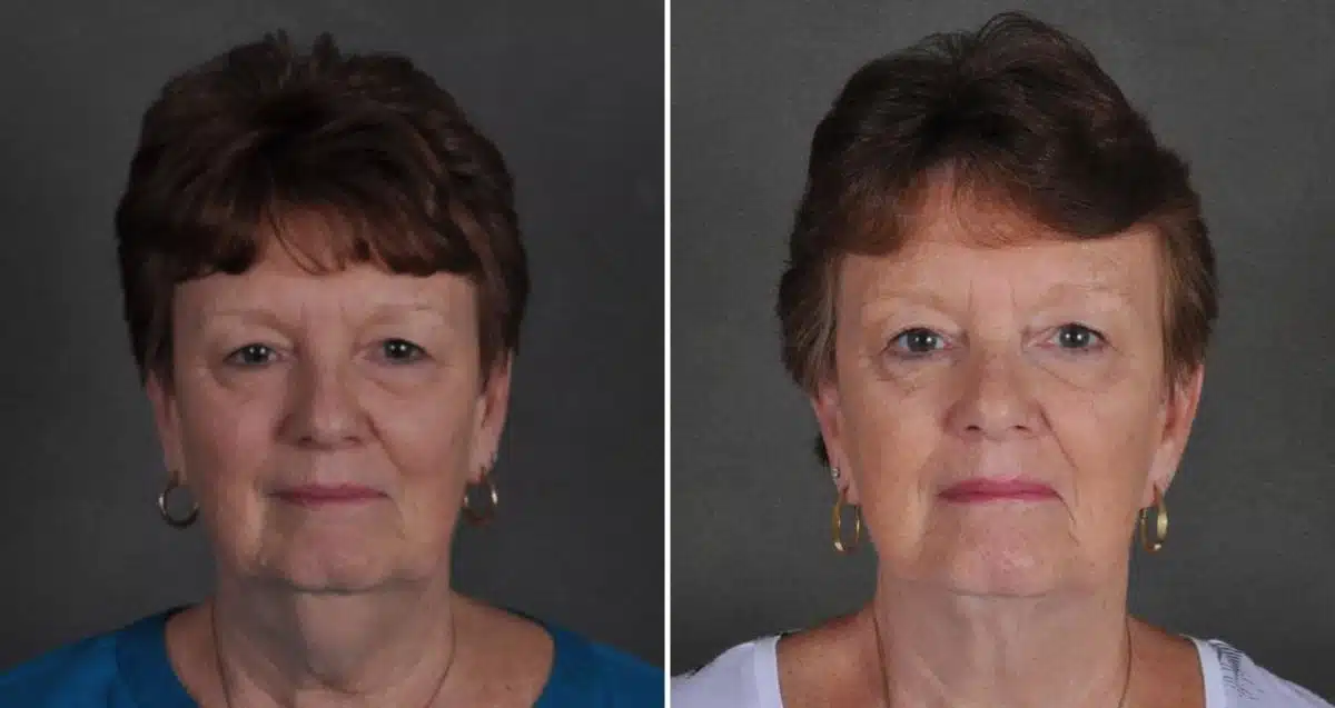 Facelift Before and After Photos in Omaha, NE, Case 10343