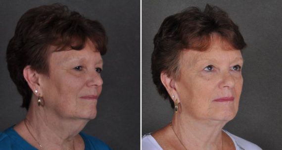 Facelift Before and After Photos in Omaha, NE, Case 10343