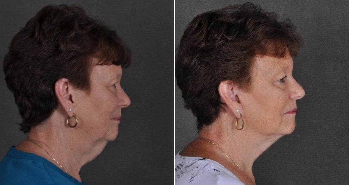 Facelift Before and After Photos in Omaha, NE, Case 10343