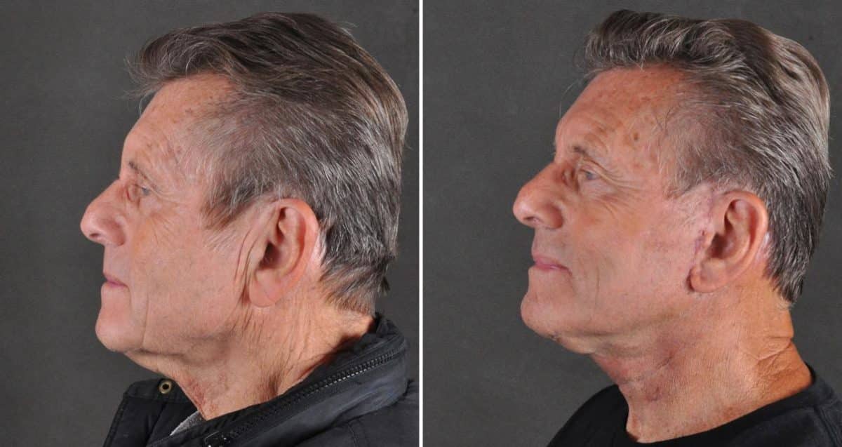 Facelift Before and After Photos in Omaha, NE, Case 10350