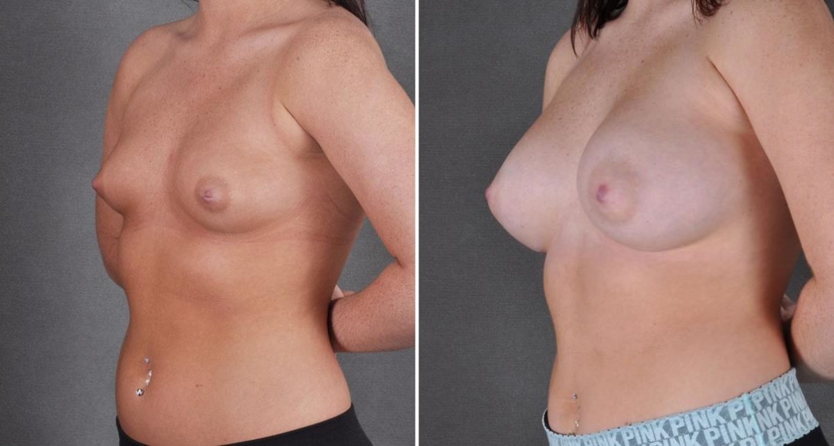 Breast Augmentation Before and After Photos in Omaha, NE, Case 9107