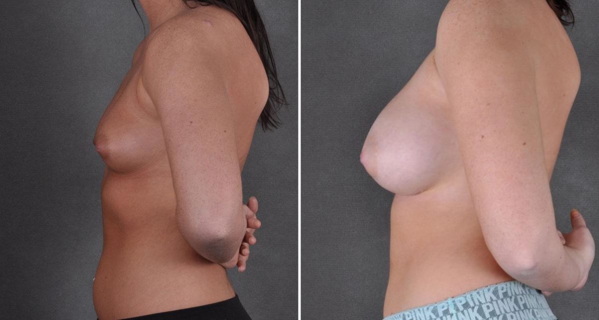 Breast Augmentation Before and After Photos in Omaha, NE, Case 9107