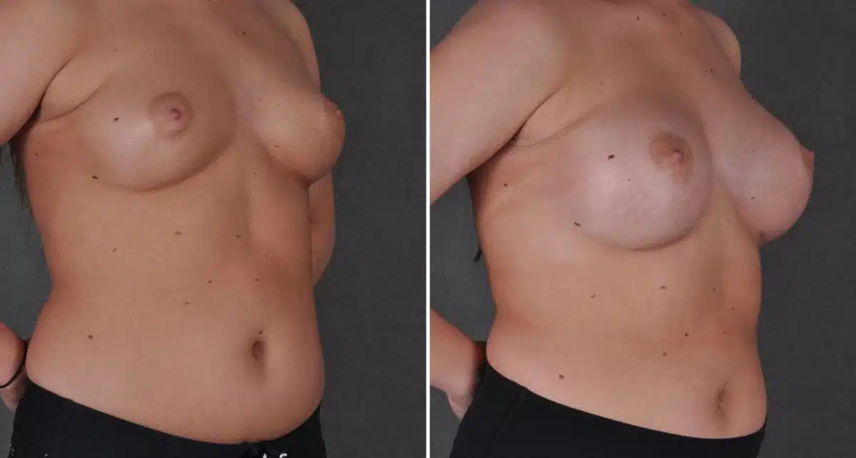 Breast Augmentation Before and After Photos in Omaha, NE, Case 9118