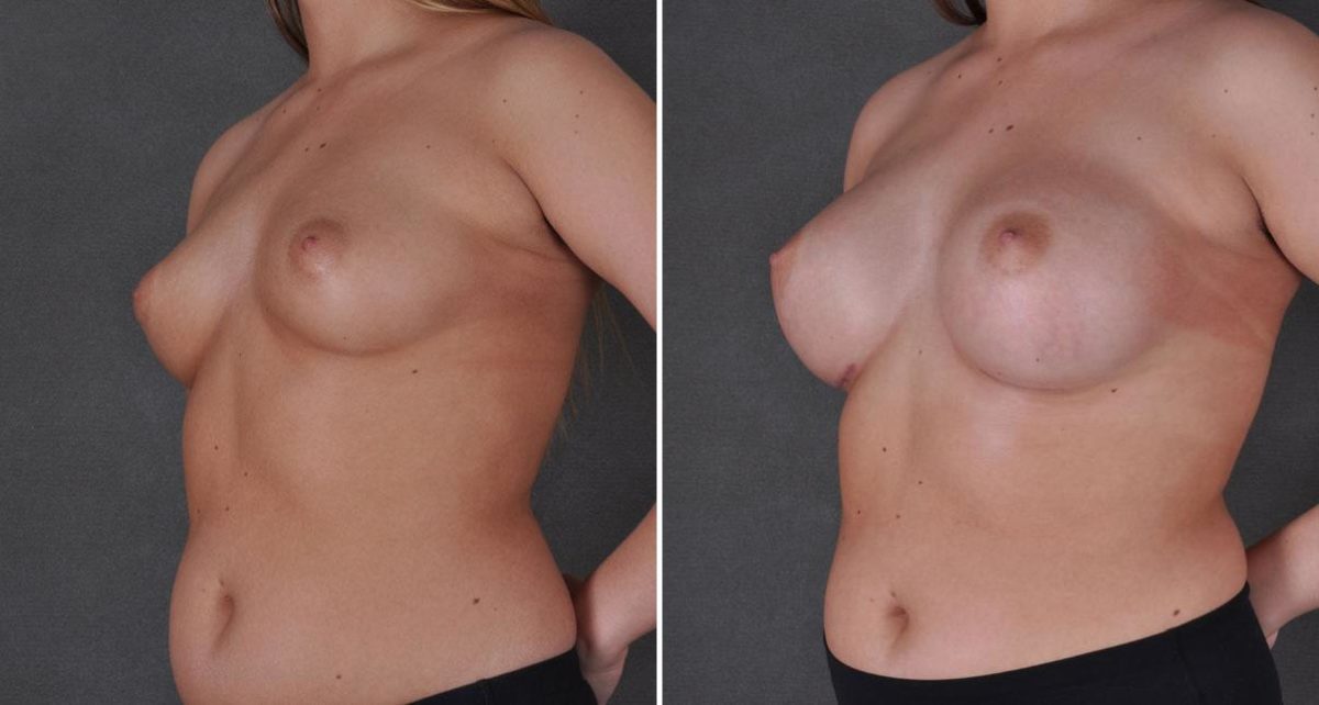 Breast Augmentation Before and After Photos in Omaha, NE, Case 9118