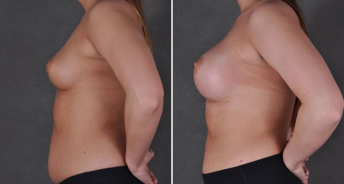 Breast Augmentation Before and After Photos in Omaha, NE, Case 9118