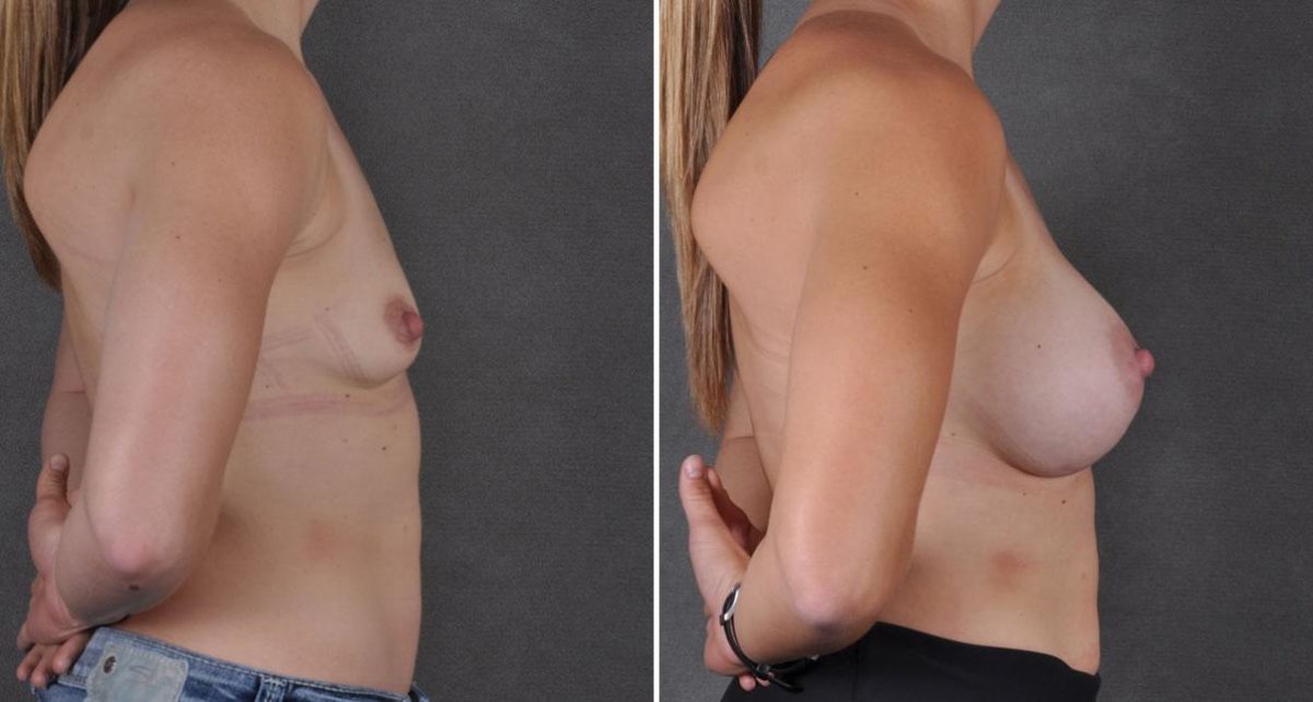 Breast Augmentation Before and After Photos in Omaha, NE, Case 9129