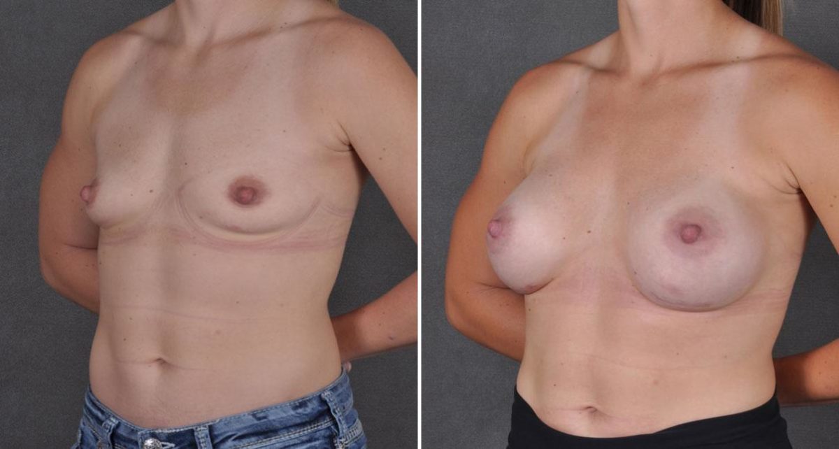 Breast Augmentation Before and After Photos in Omaha, NE, Case 9129