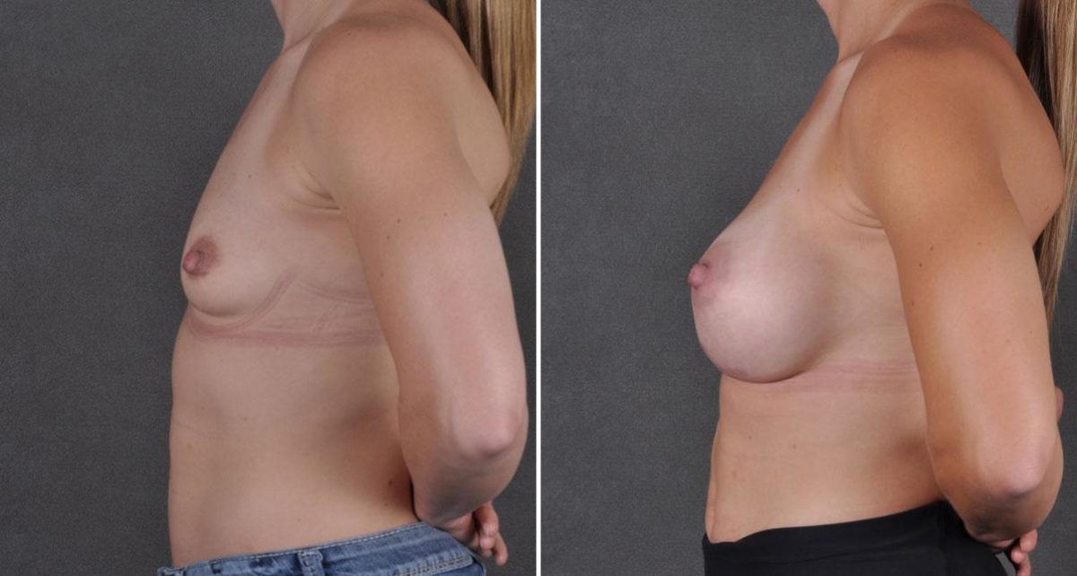 Breast Augmentation Before and After Photos in Omaha, NE, Case 9129