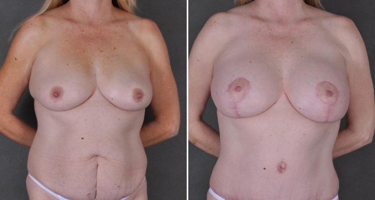 Breast Augmentation Before and After Photos in Omaha, NE, Case 9173