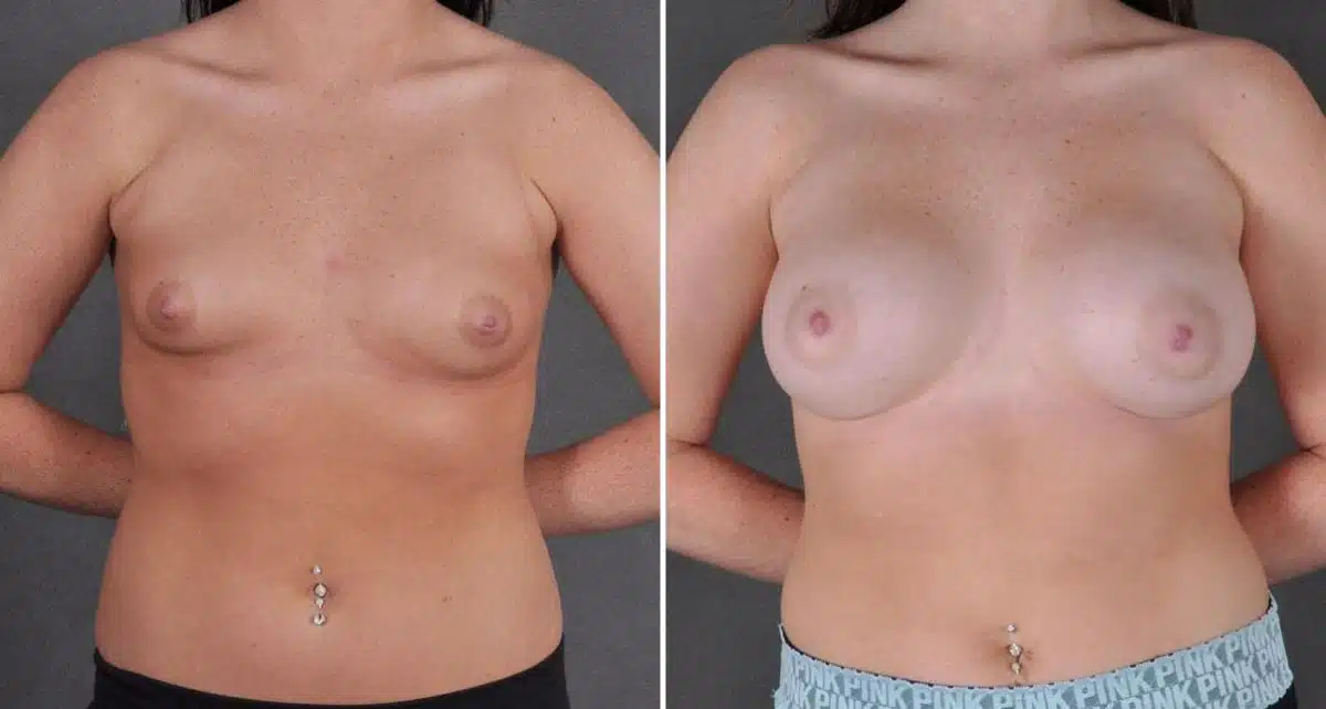 Breast Augmentation Before and After Photos in Omaha, NE, Case 9107