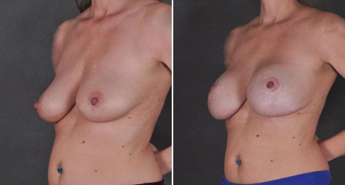 Breast Augmentation Before and After Photos in Omaha, NE, Case 9214