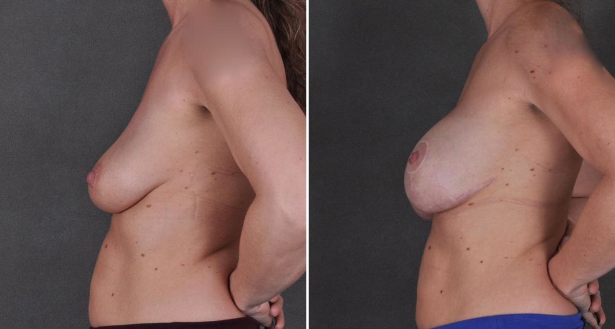 Breast Augmentation Before and After Photos in Omaha, NE, Case 9214