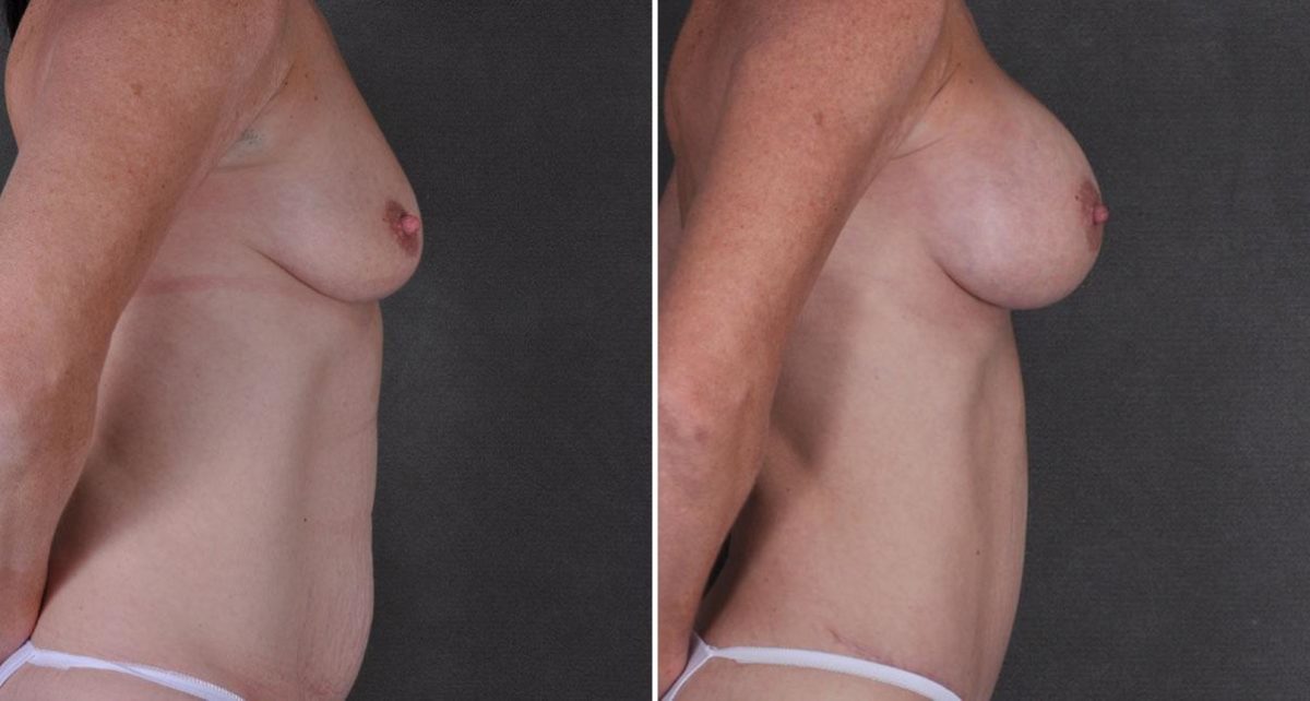 Breast Augmentation Before and After Photos in Omaha, NE, Case 9227