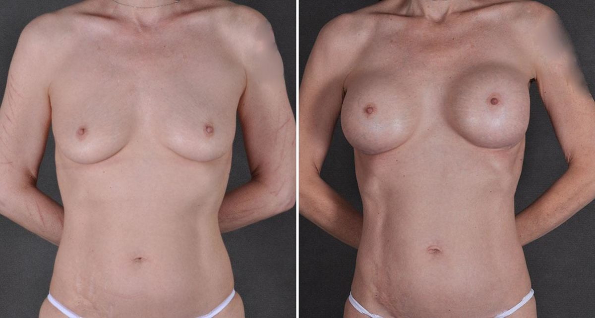 Breast Augmentation Before and After Photos in Omaha, NE, Case 9241