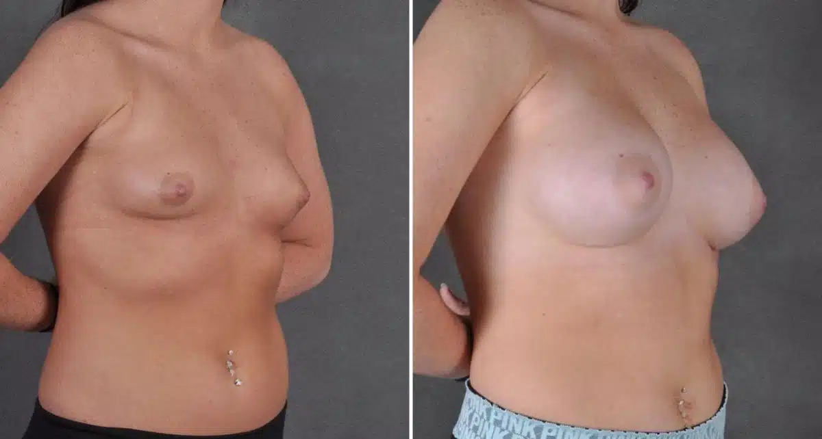 Breast Augmentation Before and After Photos in Omaha, NE, Case 9107