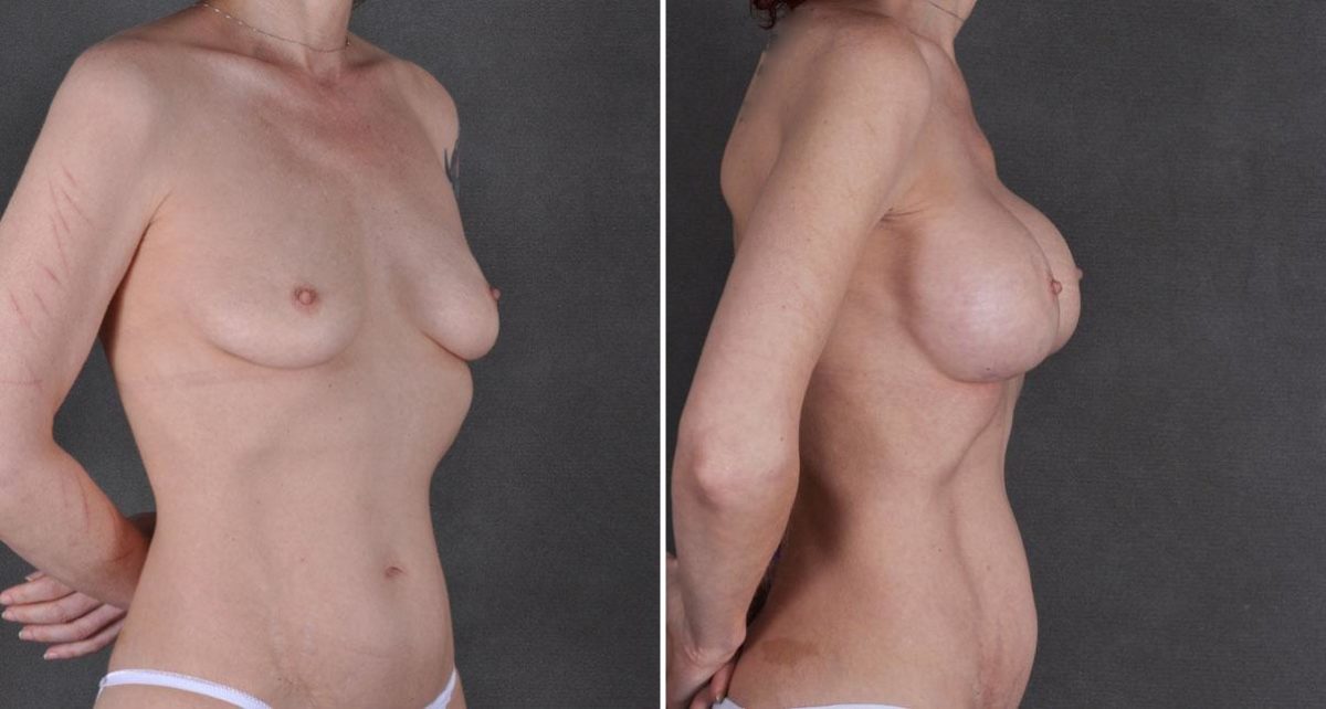 Breast Augmentation Before and After Photos in Omaha, NE, Case 9241