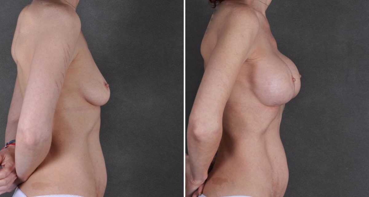 Breast Augmentation Before and After Photos in Omaha, NE, Case 9241