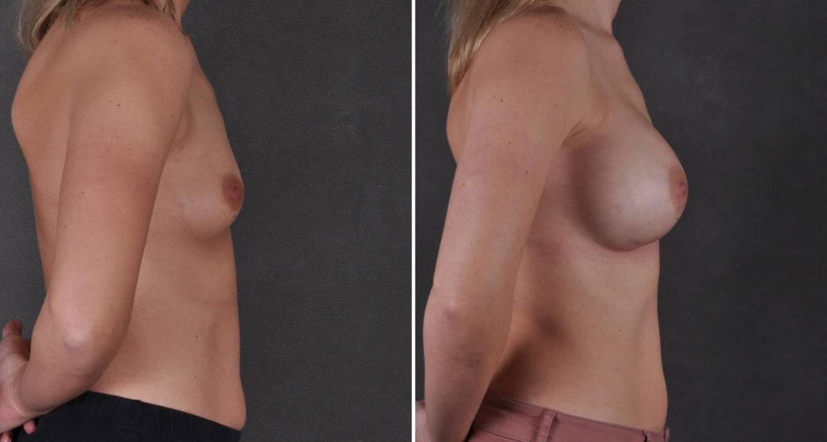 Breast Augmentation Before and After Photos in Omaha, NE, Case 9255