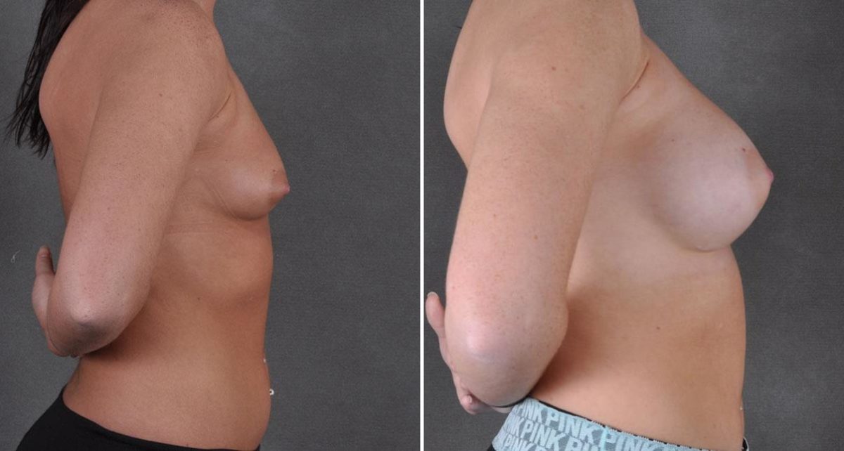 Breast Augmentation Before and After Photos in Omaha, NE, Case 9107