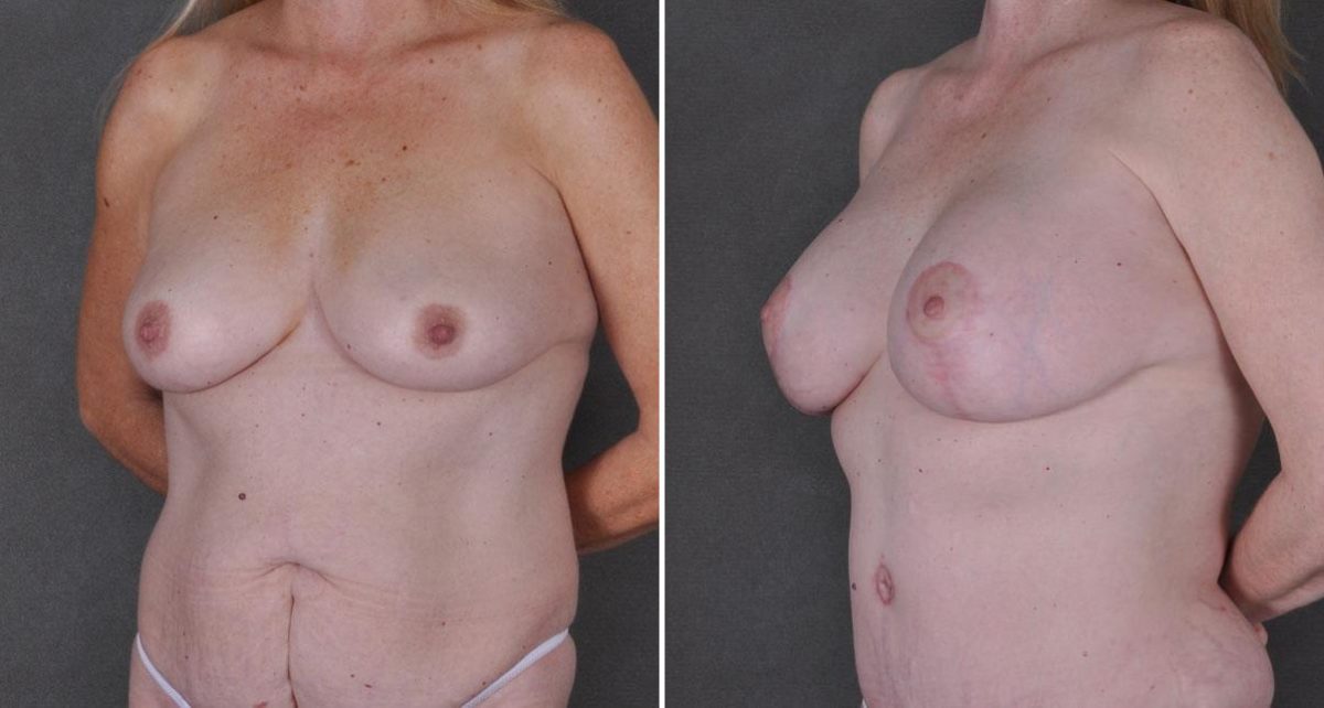 Liposuction Before and After Photos in Omaha, NE, Case 9192