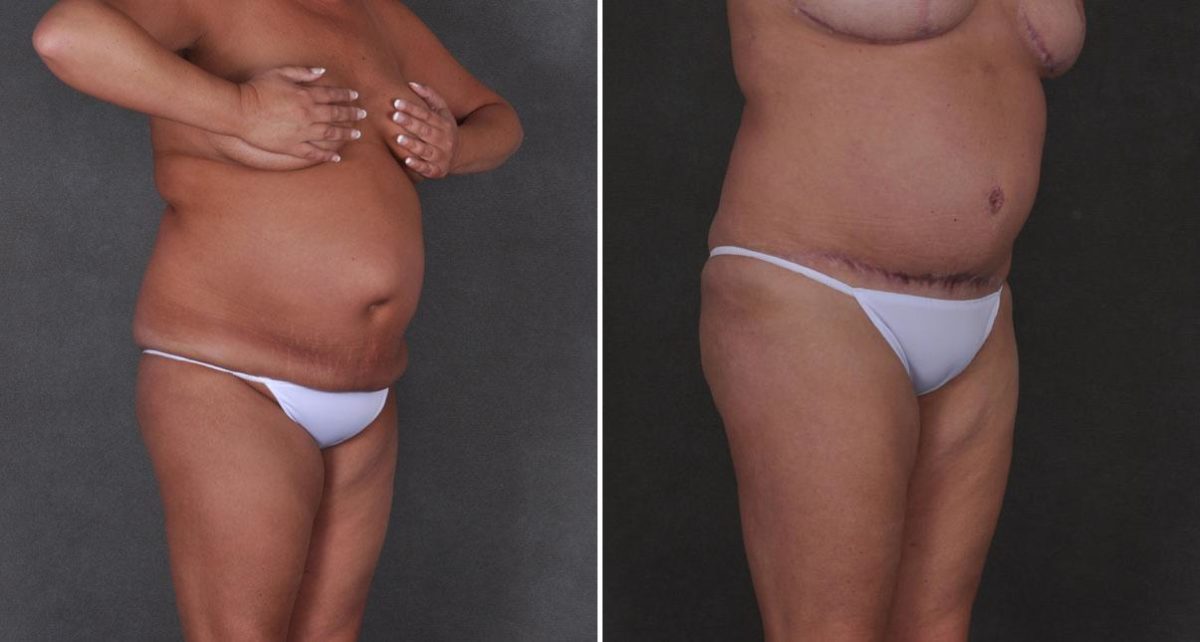 Liposuction Before and After Photos in Omaha, NE, Case 9204