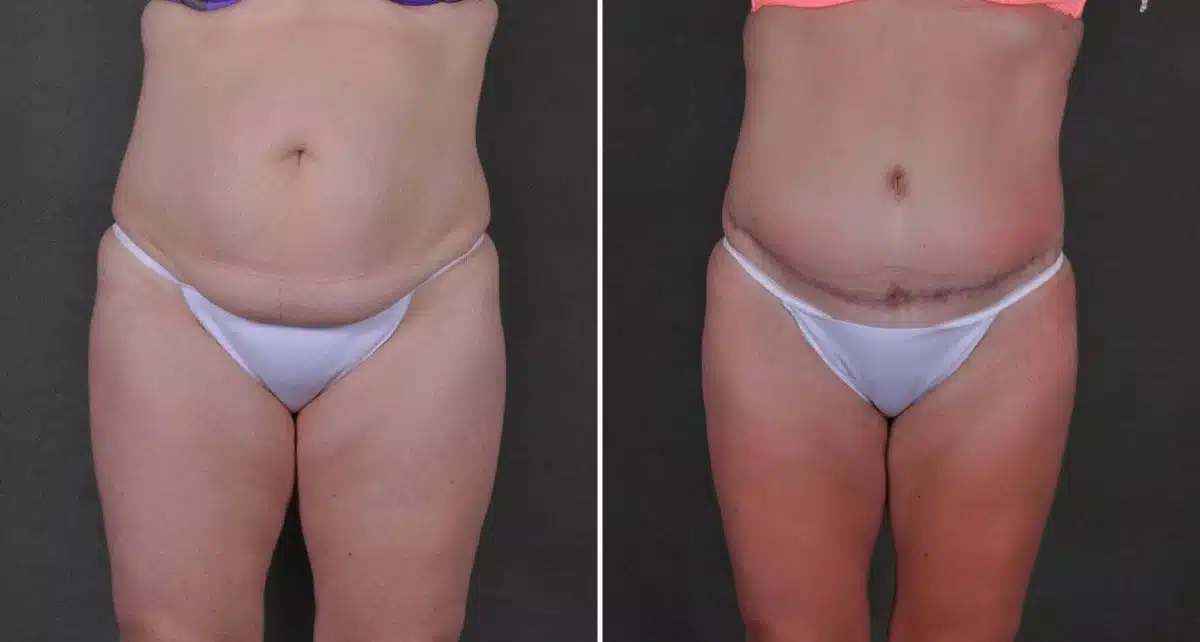 Liposuction Before and After Photos in Omaha, NE, Case 9282