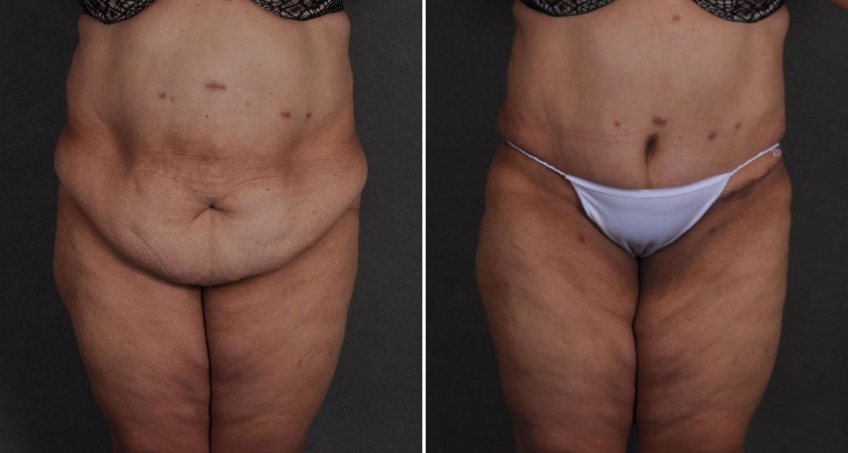 Liposuction Before and After Photos in Omaha, NE, Case 9669