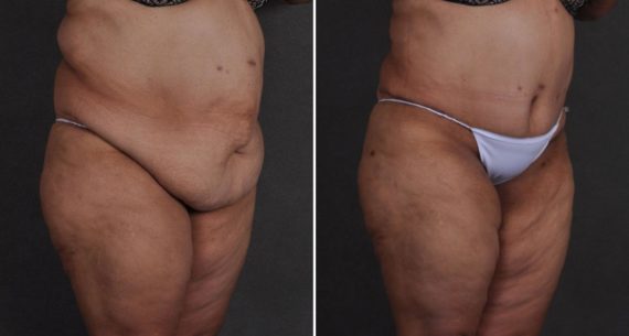 Liposuction Before and After Photos in Omaha, NE, Case 9669