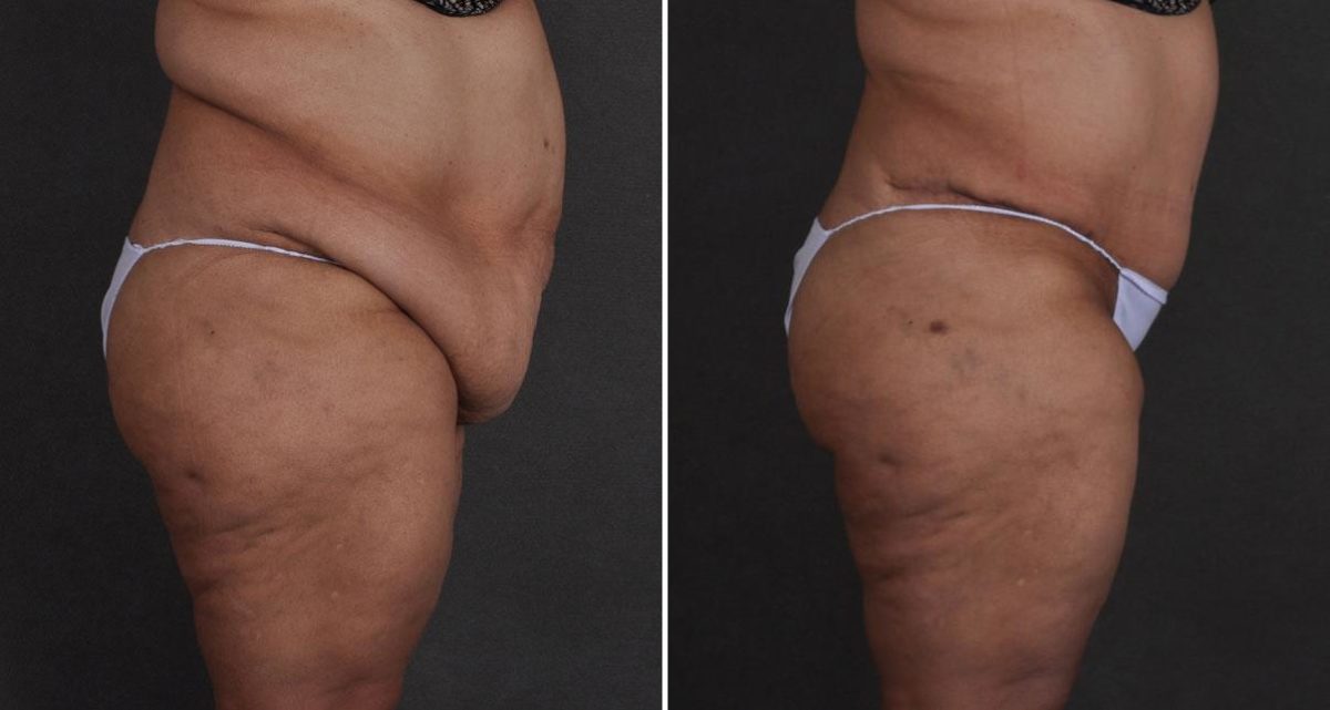 Liposuction Before and After Photos in Omaha, NE, Case 9669