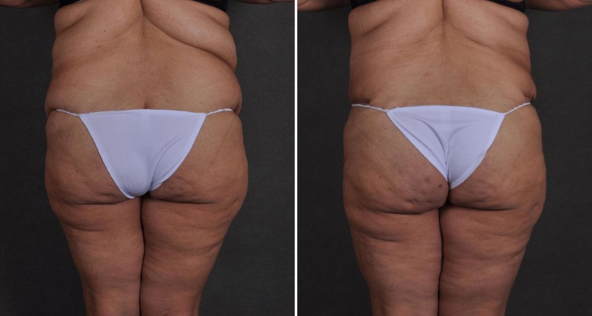 Liposuction Before and After Photos in Omaha, NE, Case 9669