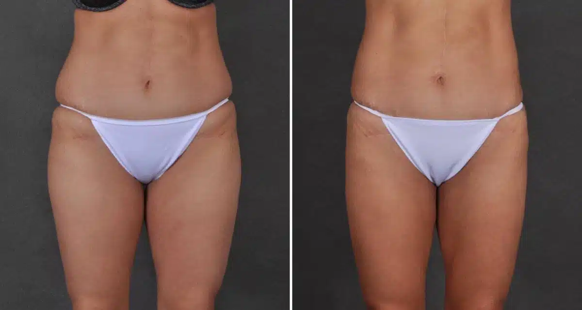 Liposuction Before and After Photos in Omaha, NE, Case 9737