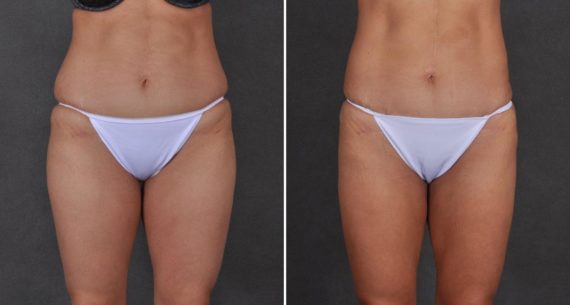 Liposuction Before and After Photos in Omaha, NE, Case 9737