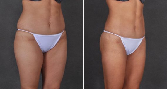 Liposuction Before and After Photos in Omaha, NE, Case 9737