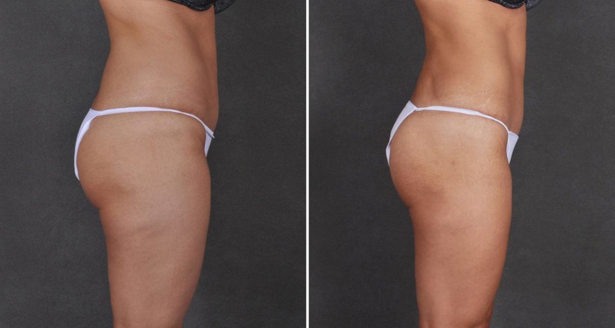 Liposuction Before and After Photos in Omaha, NE, Case 9737