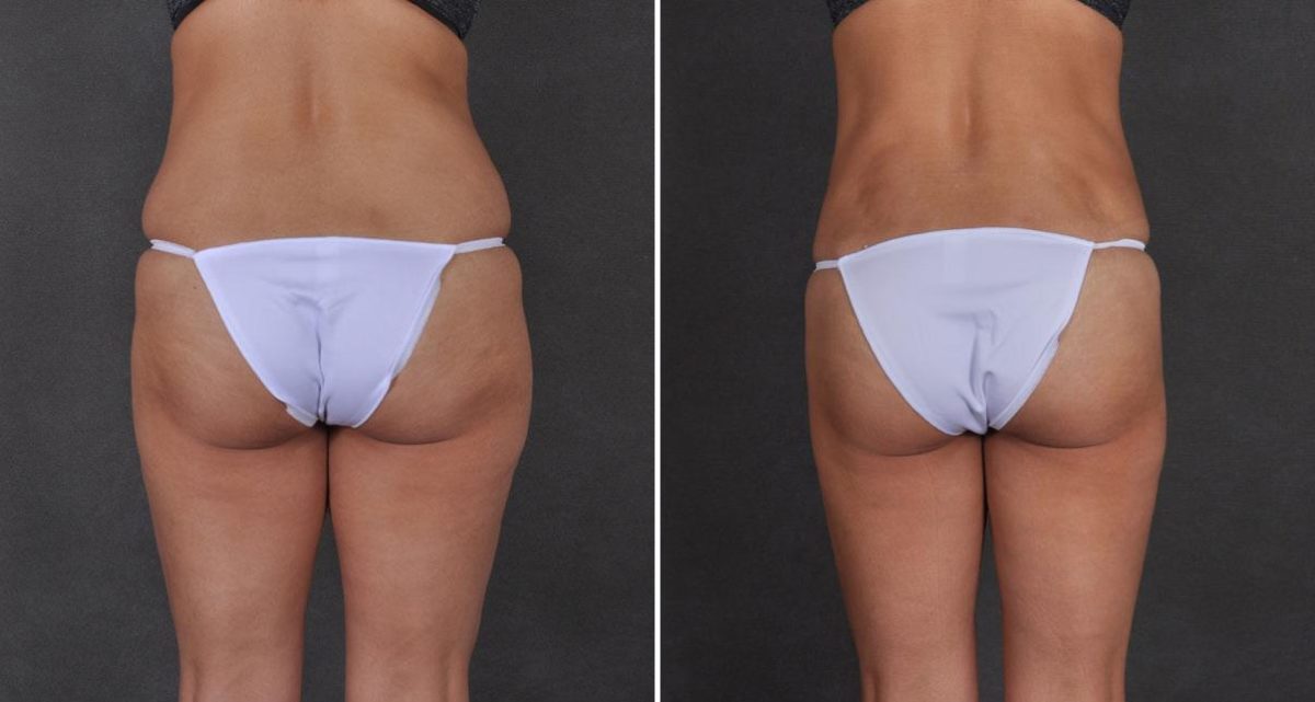 Liposuction Before and After Photos in Omaha, NE, Case 9737