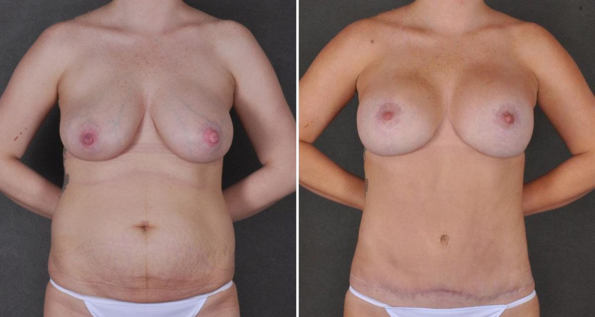 Liposuction Before and After Photos in Omaha, NE, Case 9771