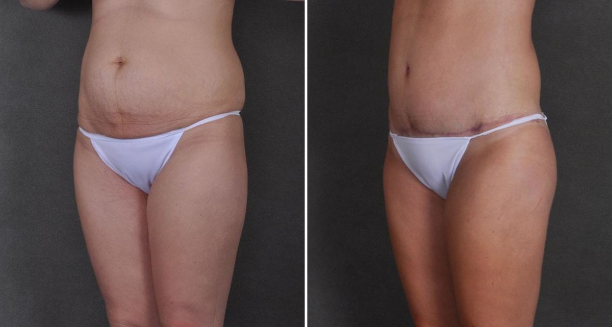 Liposuction Before and After Photos in Omaha, NE, Case 9771