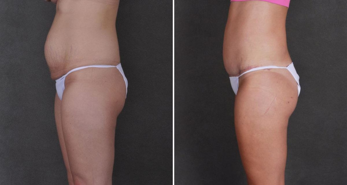 Liposuction Before and After Photos in Omaha, NE, Case 9771