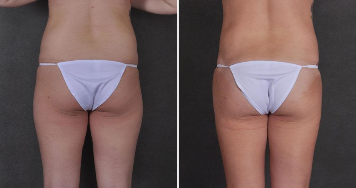 Liposuction Before and After Photos in Omaha, NE, Case 9771