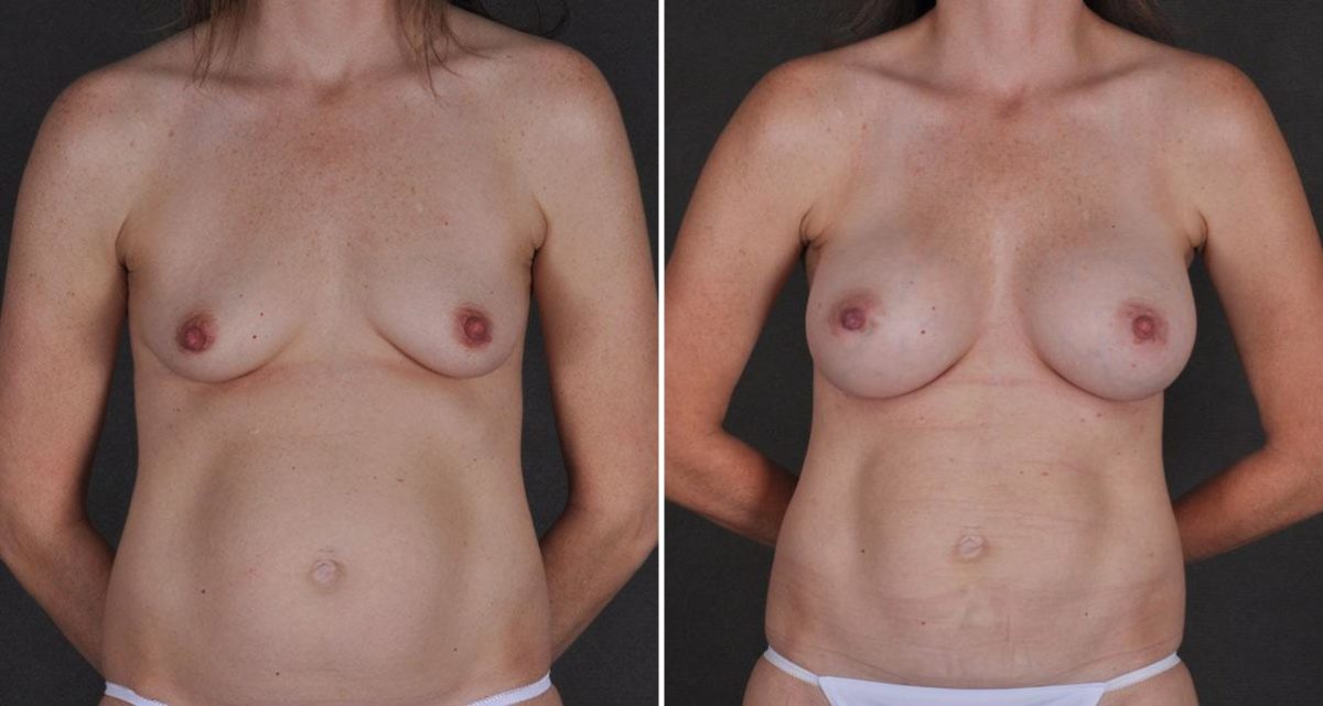 Liposuction Before and After Photos in Omaha, NE, Case 9790