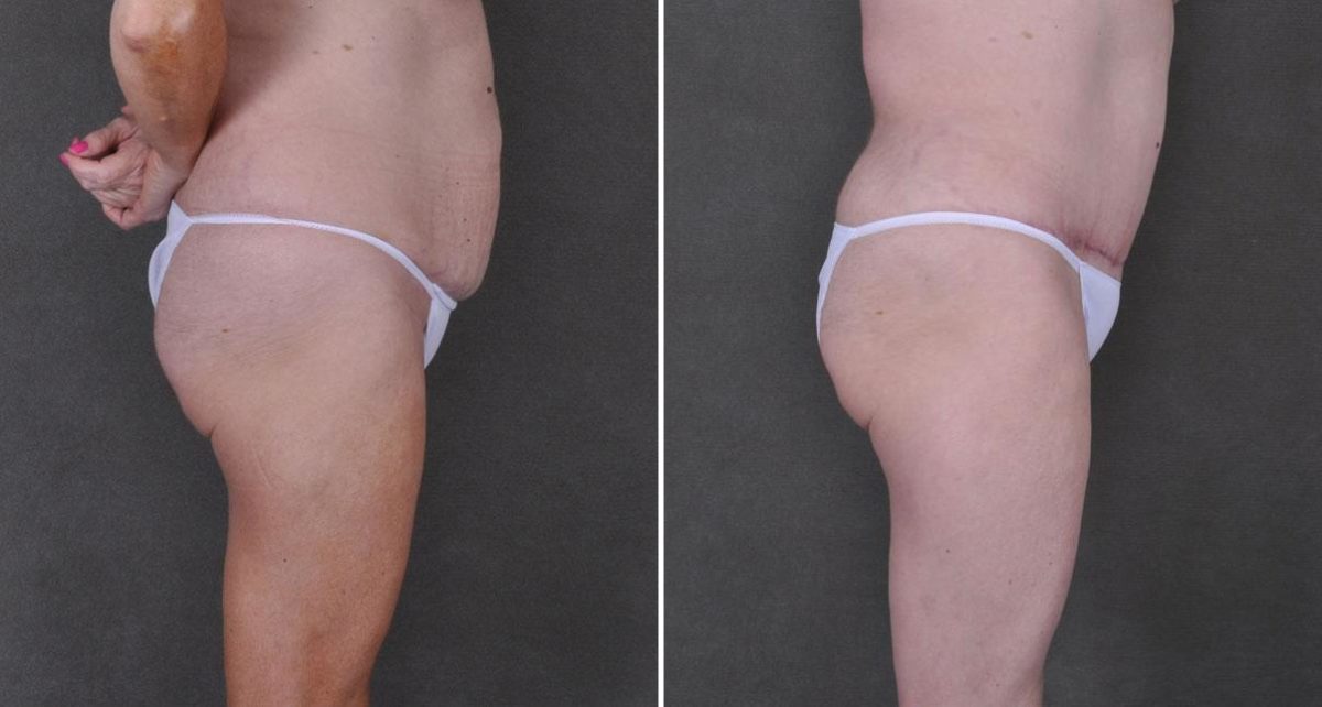 Liposuction Before and After Photos in Omaha, NE, Case 9192