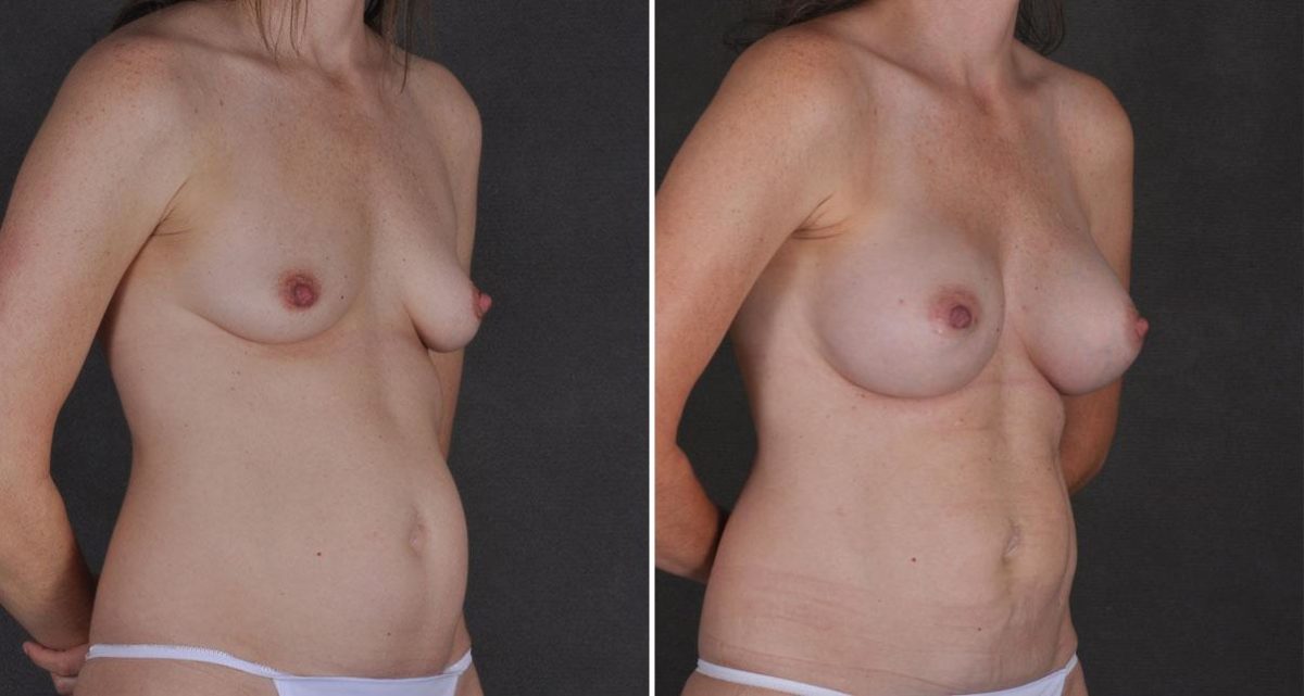 Liposuction Before and After Photos in Omaha, NE, Case 9790