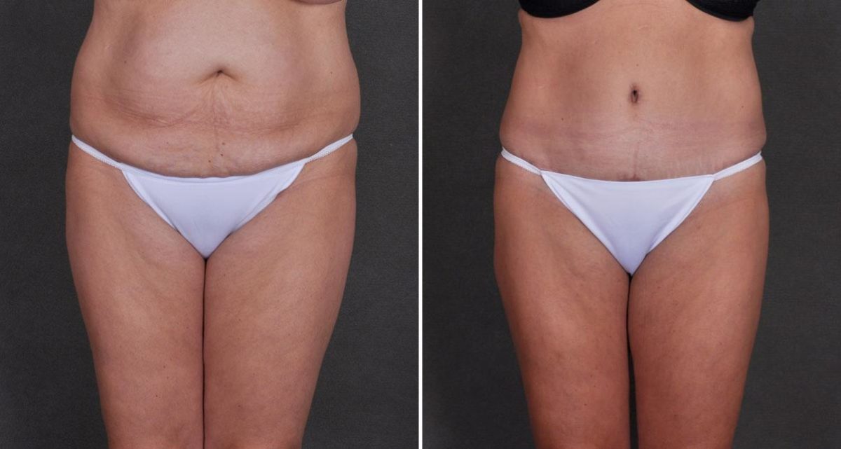 Case 9824, Liposuction Before and After Photos Liposuction Before and After Photos in Omaha, NE, Case 9824