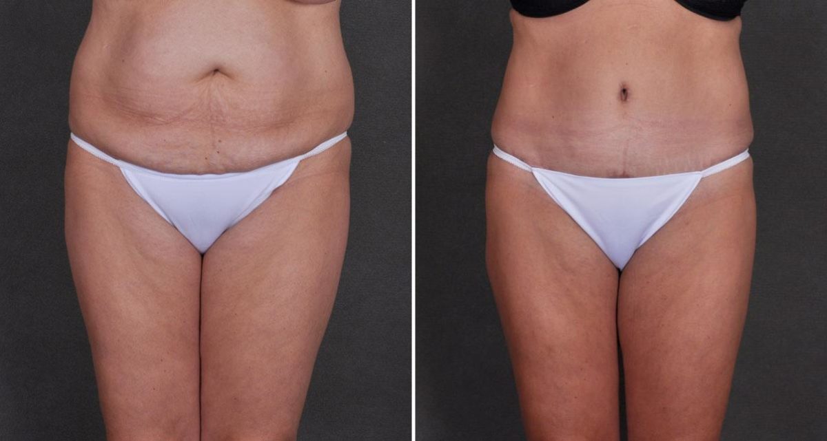 Liposuction Before and After Photos in Omaha, NE, Case 9824