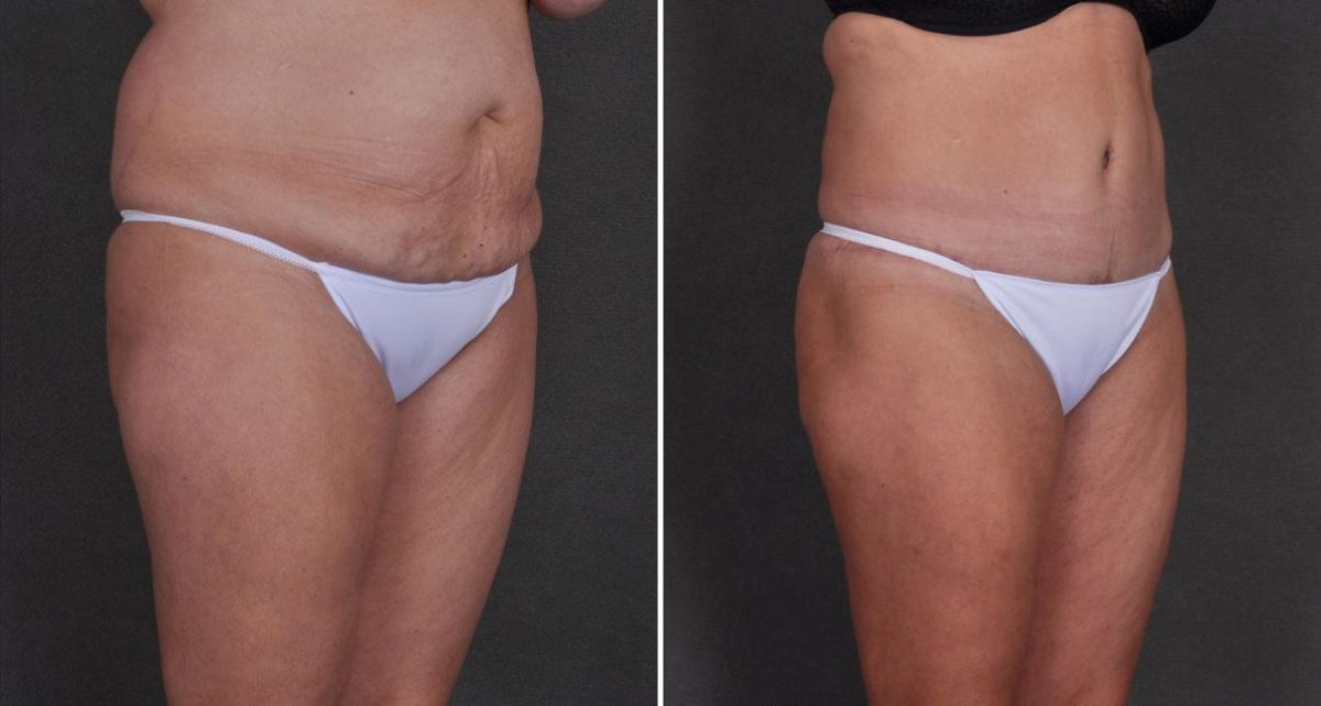 Liposuction Before and After Photos in Omaha, NE, Case 9824